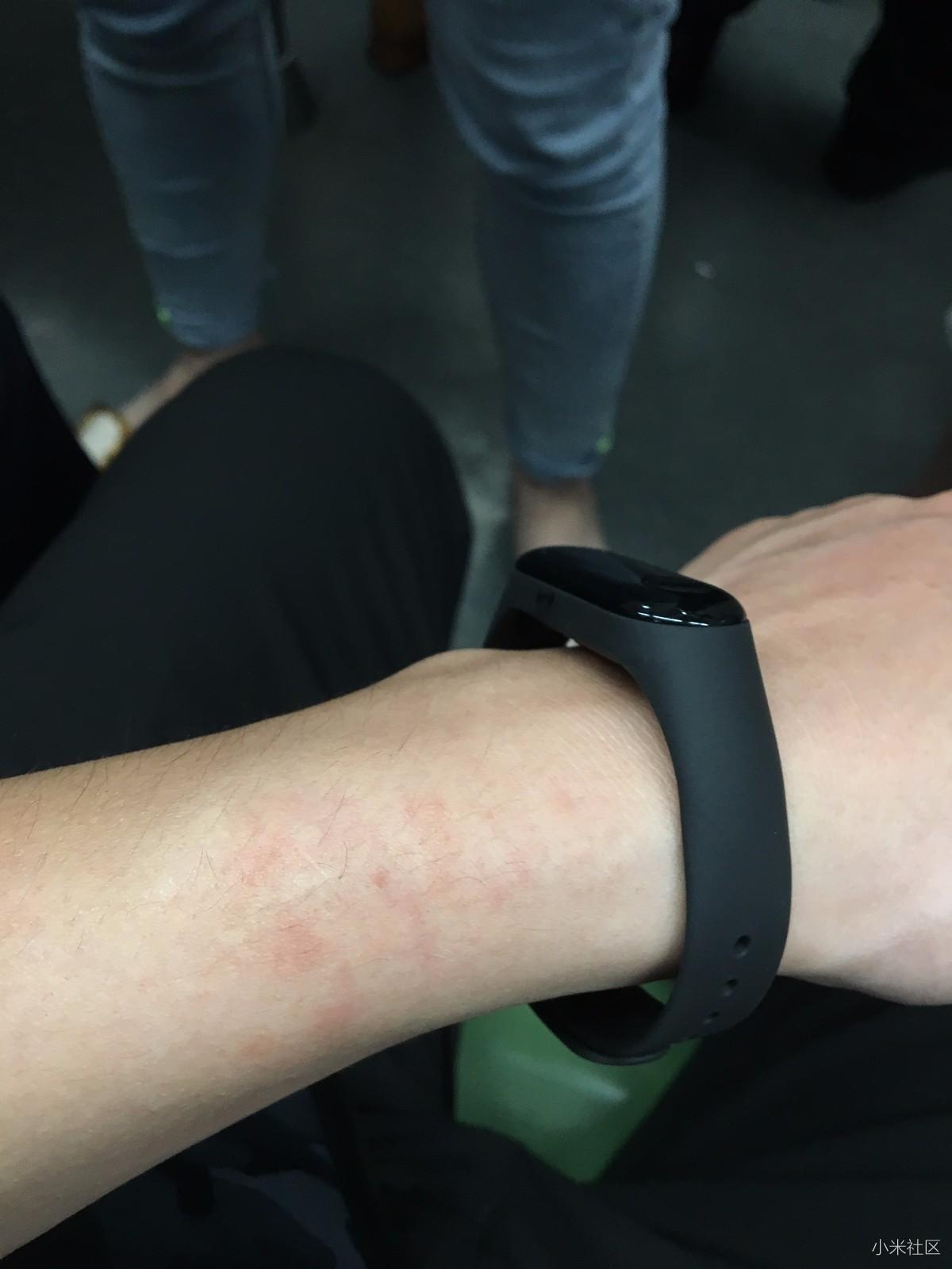 小米手环3带之后手腕起红点,奇痒无比