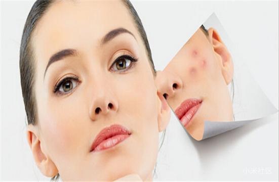 脸上的红血丝怎么去,修复损伤角质层才能去除